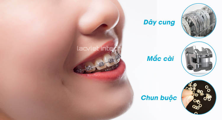 Cấu tạo niềng răng mắc cài kim loại gồm mắc cài, dây cung và dây chun (đối với mắc cài kim loại thường)