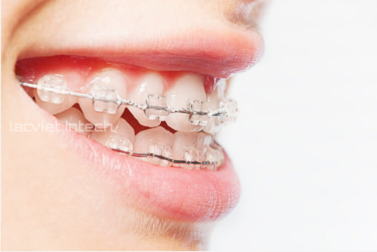 Niềng răng mắc cài sứ cải thiện hàm răng thưa hiệu quả