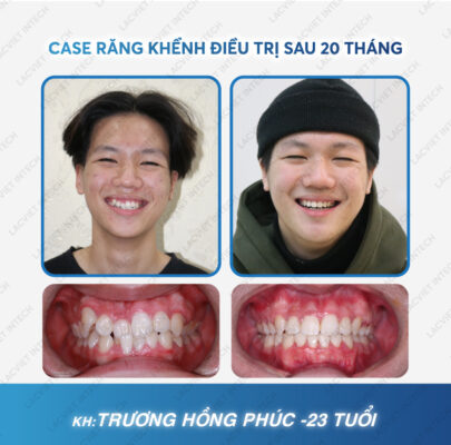Kết quả khách hàng khi niềng răng quặp tại nha khoa Lạc Việt Intech