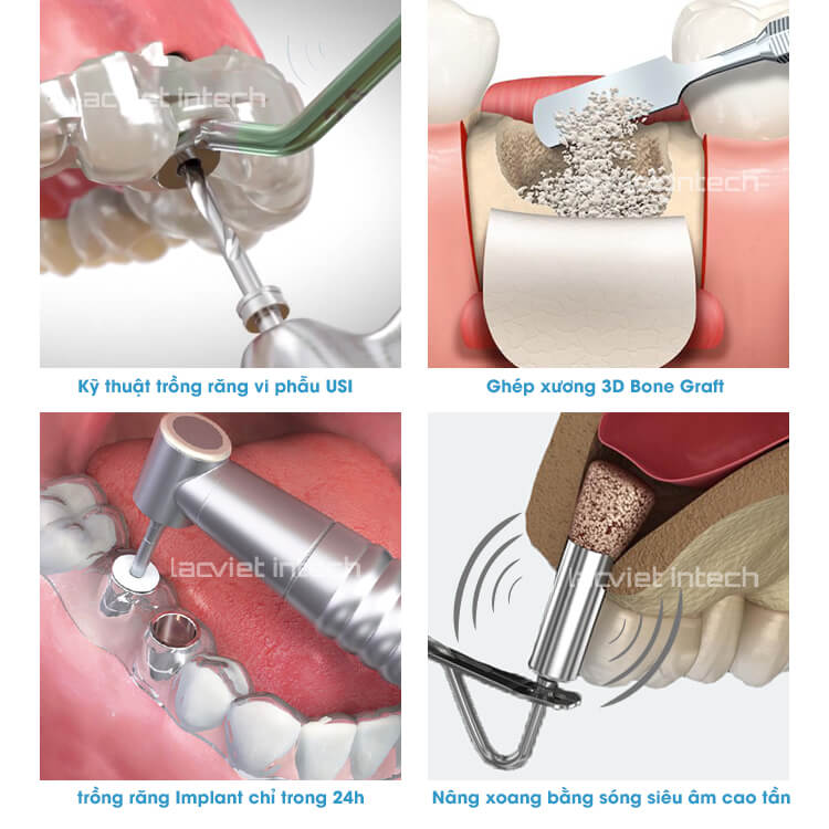 Cac ky thuat trong implant moi nhat tai nha khoa lac viet