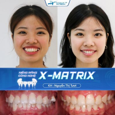 Khách hàng thay đổi toàn diện khi niềng răng bằng công nghệ X-Matrix tại Nha khoa Lạc Việt Intech