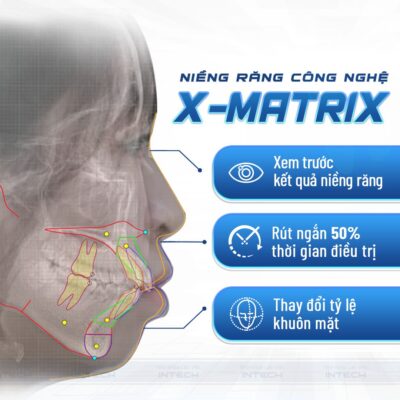 Niềng răng công nghệ X-Matrix mang đến nhiều ưu điểm vượt trội cho khách hàng 