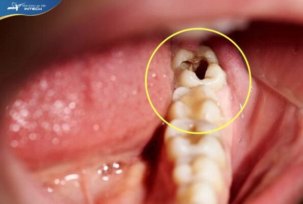 Răng khôn khó vệ sinh nên thường gây sâu, ảnh hưởng các răng bên cạnh