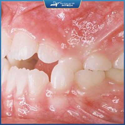 Răng bị sai lệch khớp cắn niềng răng là giải pháp số một làm thay đổi hàm răng của bạn