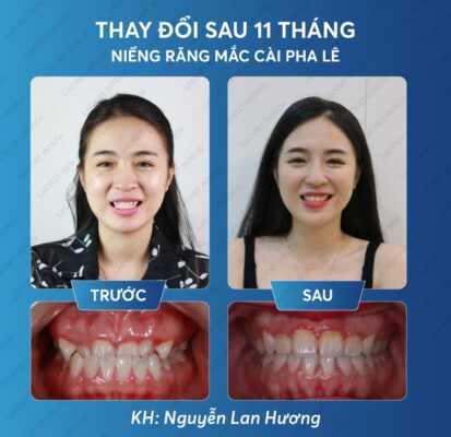 Kết quả niềng răng mắc cài pha lê khách hàng thực hiện nha khoa Lạc Việt Intech Kết quả niềng răng mắc cài pha lê khách hàng thực hiện nha khoa Lạc Việt Intech