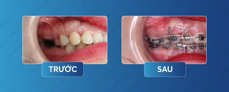 So sánh kết quả khách hàng trước và sau khi niềng răng mất răng số 7