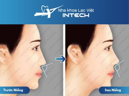 Kết quả thay đổi tích cực mũi sau khi thực hiện niềng răng Kết quả thay đổi tích cực mũi sau khi thực hiện niềng răng