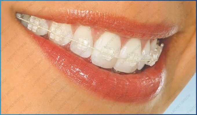 Niềng răng mắc cài pha lê mang lại giá trị thẩm mỹ cao Niềng răng mắc cài pha lê mang lại giá trị thẩm mỹ cao