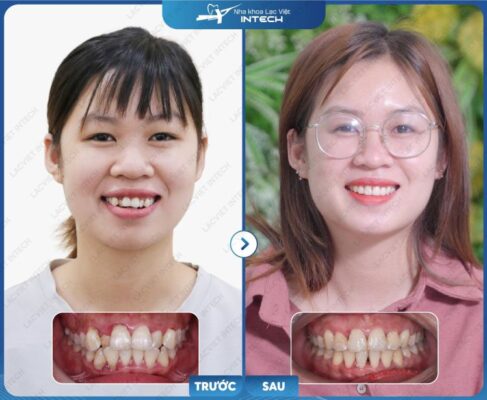 Kết quả niềng răng trong suốt khách hàng đạt được mang lại thẩm mỹ cao