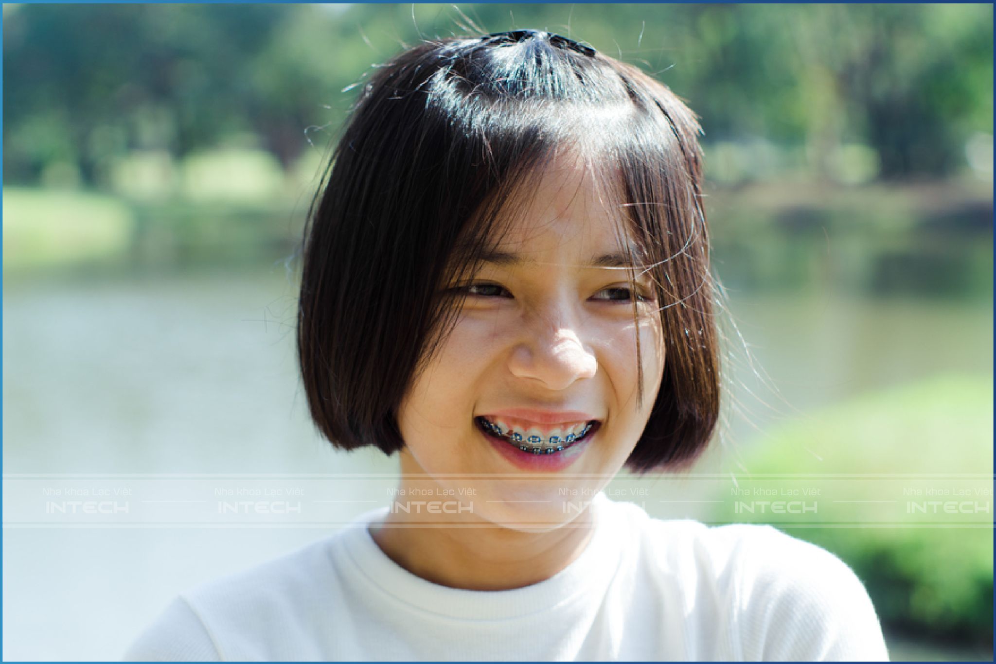 Niềng răng sớm cho trẻ để cải thiện thẩm mỹ và khả năng ăn nhai