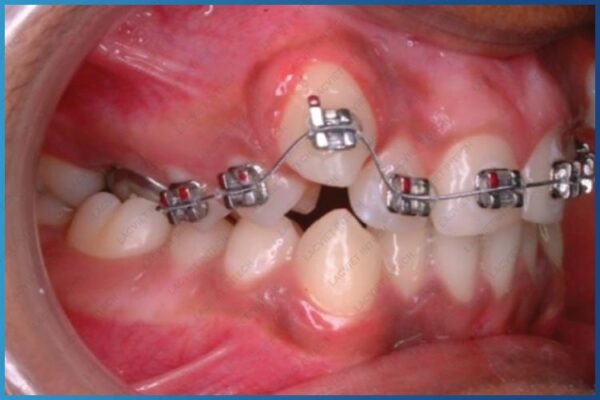 Cận cảnh tình trạng răng móm thực tế Cận cảnh tình trạng răng móm thực tế