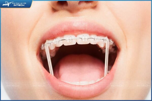 Giai đoạn thay chun và dây cung trong khi niềng răng Giai đoạn thay chun và dây cung trong khi niềng răng