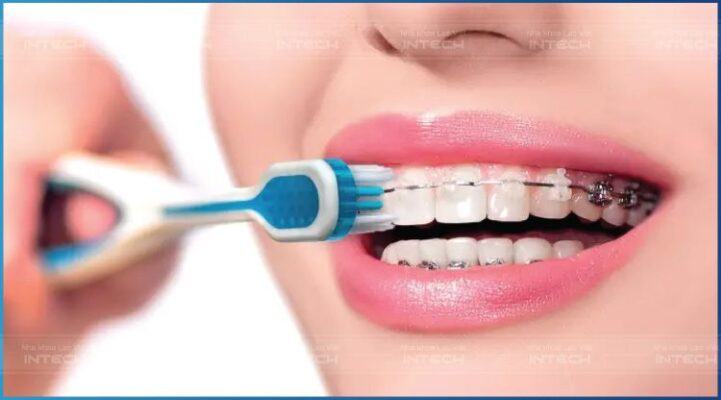 Chăm sóc răng miệng sau khi niềng răng bằng cách dùng bàn chải đúng cách Chăm sóc răng miệng sau khi niềng răng bằng cách dùng bàn chải đúng cách