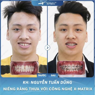 Kết quả khách hàng niềng răng thưa thực tế tại Lạc Việt Intech
