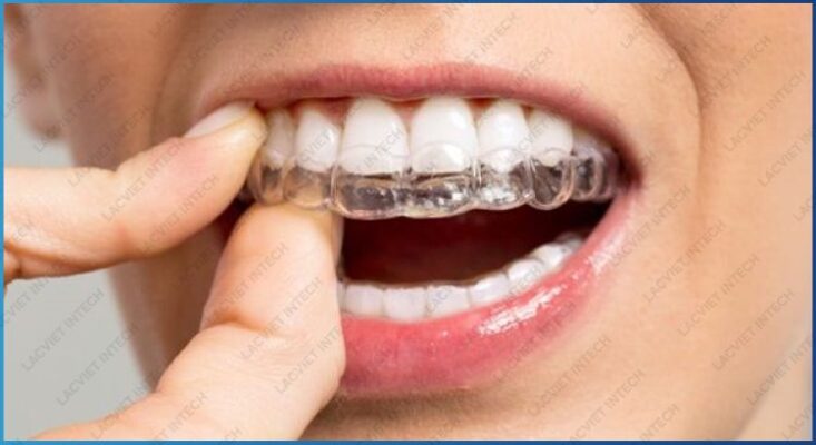 Khắc phục tình trạng răng khớp cắn sau bằng công nghệ invisalign