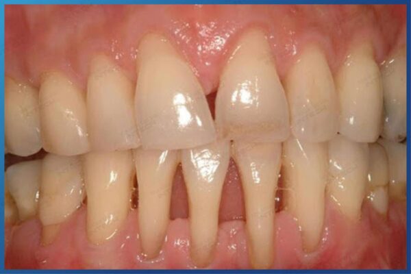 Sau khi niềng răng bị tiêu xương, tụt lưỡi có thể bắt gặp 
