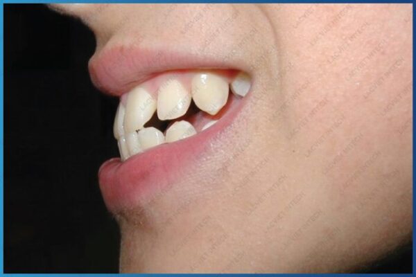 Một trong những dấu hiệu răng dễ nhận biết nhất
