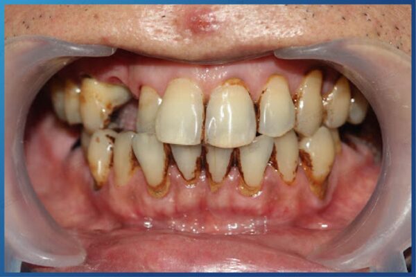 Viêm lợi, hôi miệng là một trong những dấu hiệu có thể gặp sau khi niềng răng