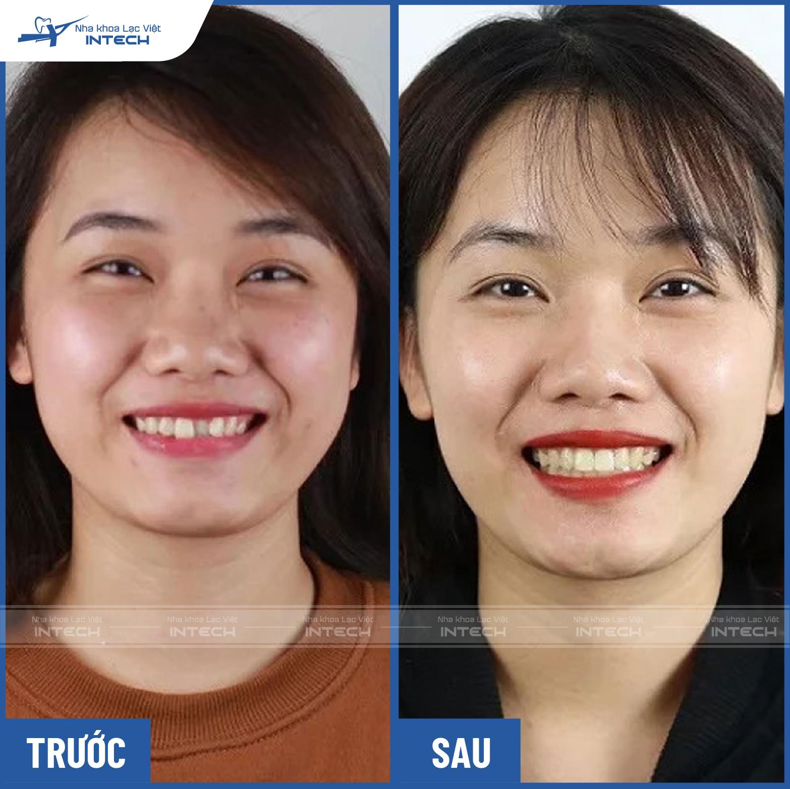 Ảnh Nguyễn Thị Hải Yến trước và sau niềng răng trong suốt Ảnh Nguyễn Thị Hải Yến trước và sau niềng răng trong suốt