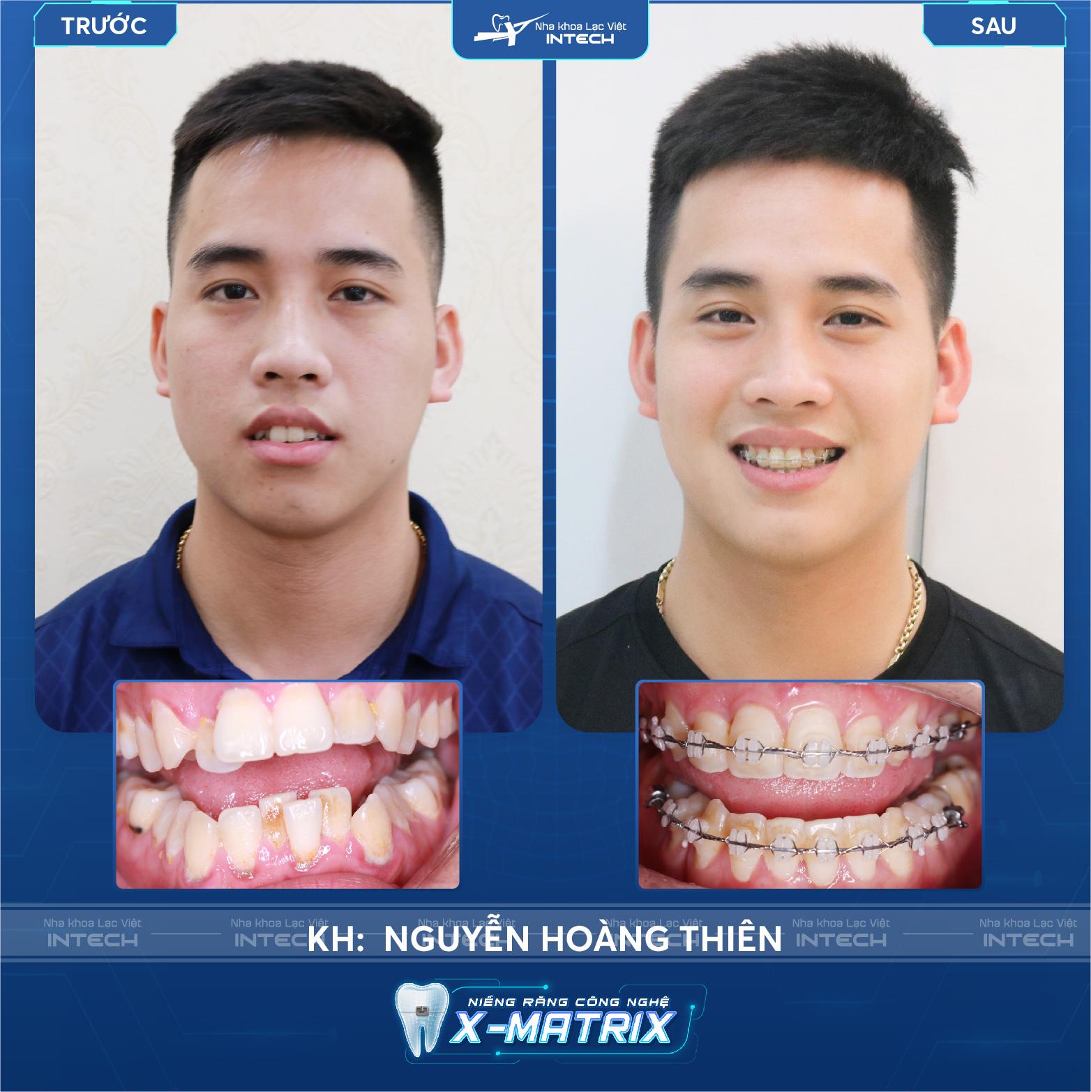 Ảnh Nguyễn Hoàng Thiên trước và sau niềng mắc cài sứ Ảnh Nguyễn Hoàng Thiên trước và sau niềng mắc cài sứ