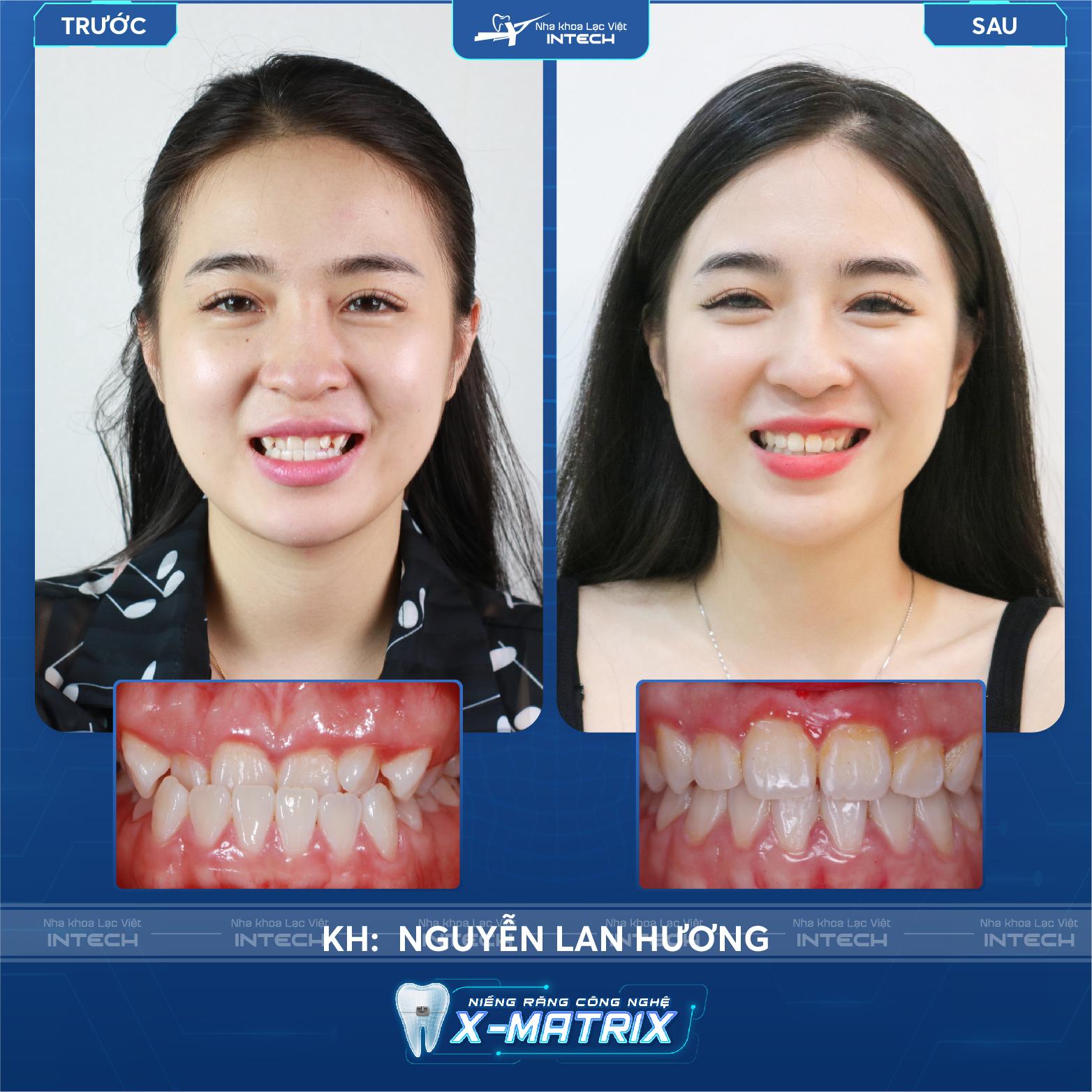 Ảnh Nguyễn Lan Hương trước và sau niềng mắc cài sứ Ảnh Nguyễn Lan Hương trước và sau niềng mắc cài sứ