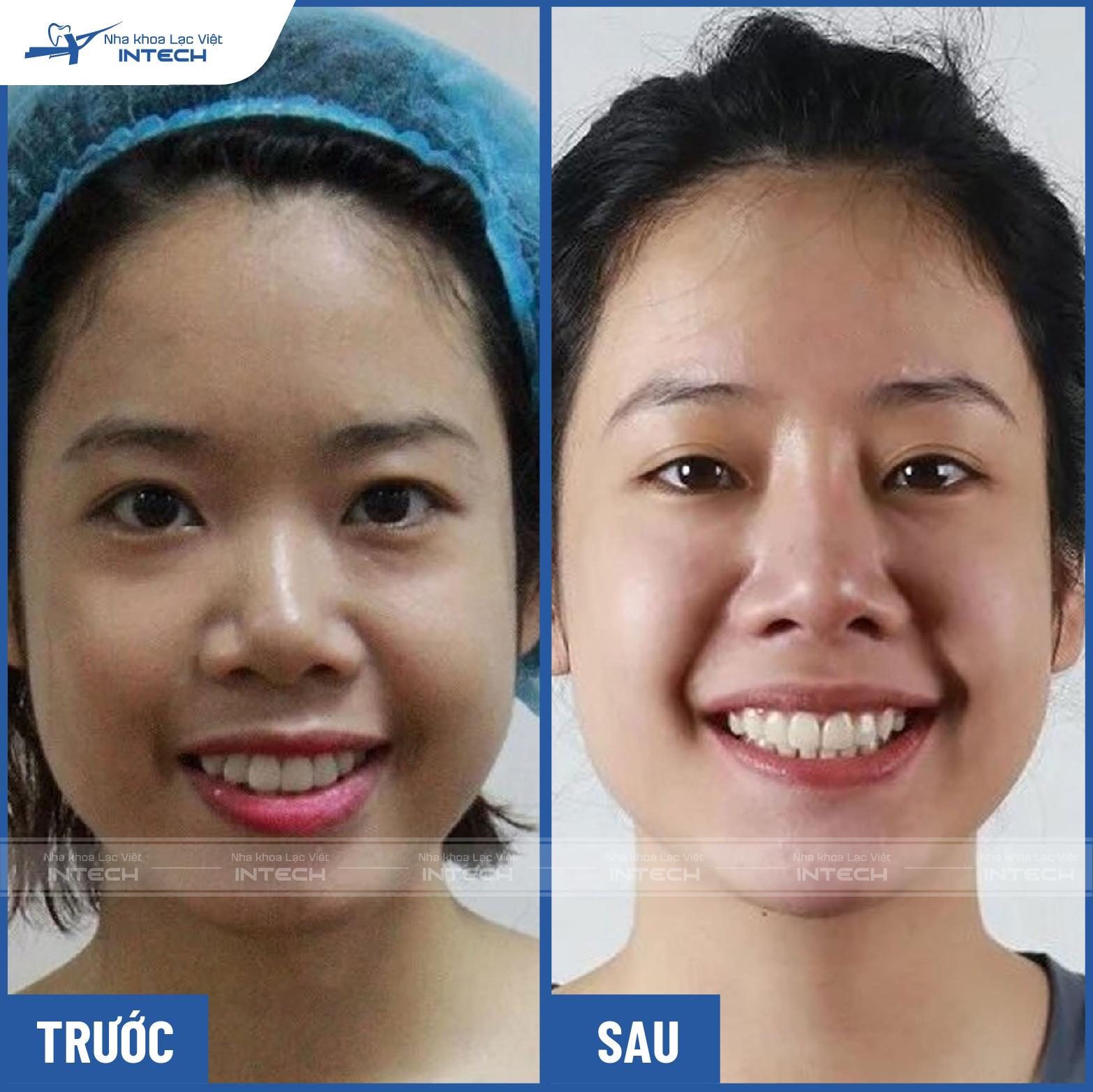 Ảnh Nguyễn Thu Thủy trước và sau niềng răng invisalign Ảnh Nguyễn Thu Thủy trước và sau niềng răng invisalign