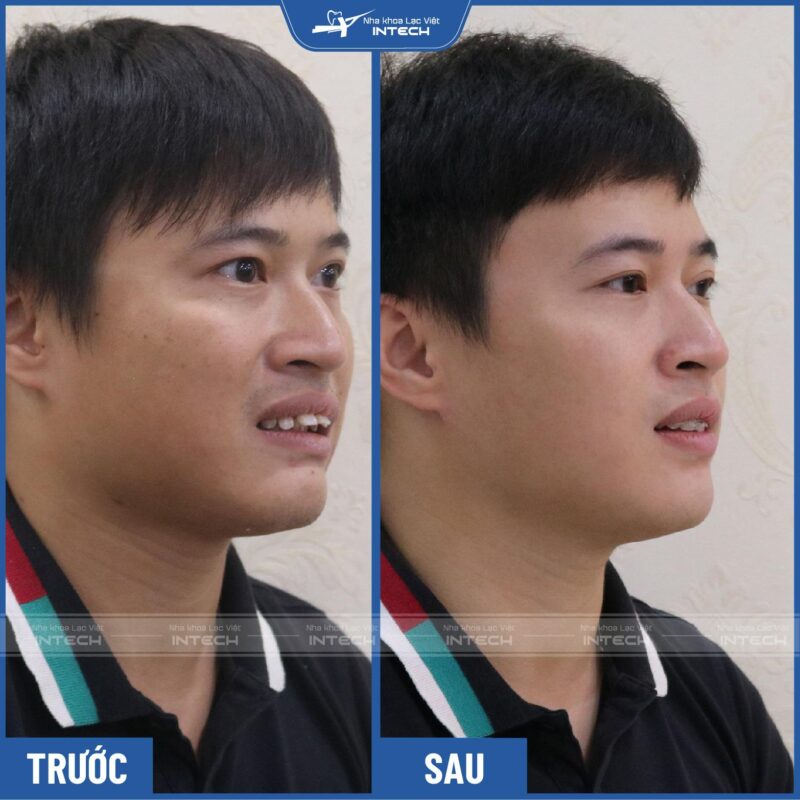 Nguyễn Việt Long trước và sau khi niềng răng bằng mắc cài sứ Nguyễn Việt Long trước và sau khi niềng răng bằng mắc cài sứ