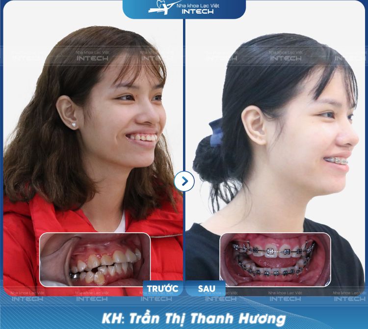 Bạn Trần Thanh Hương trước và sau khi niềng răng bằng mắc cài kim loại Bạn Trần Thanh Hương trước và sau khi niềng răng bằng mắc cài kim loại