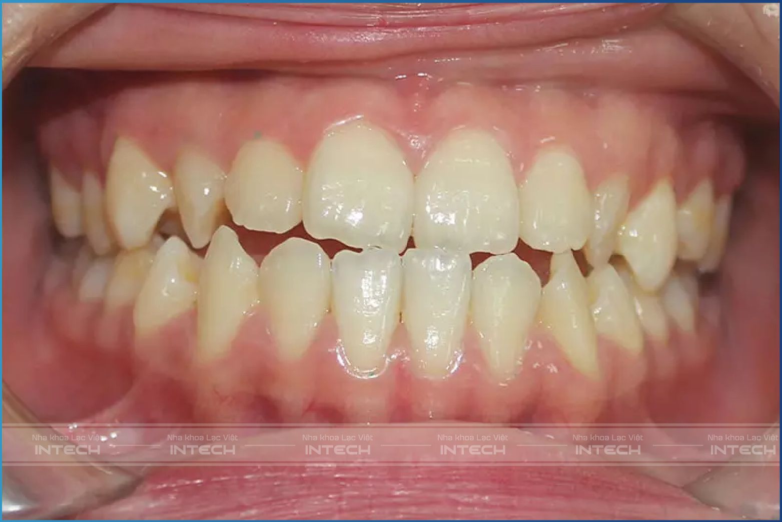 Biểu hiện rặng lệch khớp cắn đối đầu Biểu hiện rặng lệch khớp cắn đối đầu