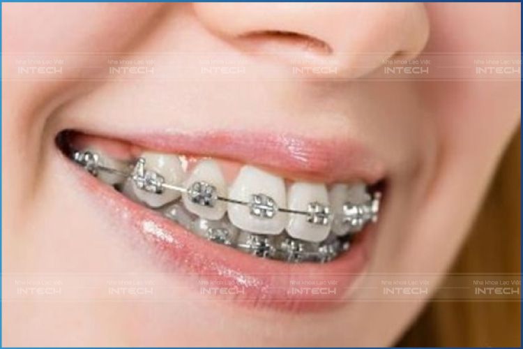 Thời gian niềng răng hô trường hợp hô nhẹ và vừa mất thời gian từ 2 đến 2,5 năm