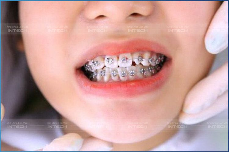 Theo chuyên gia khuyến cáo thì độ tuổi từ 14 đến 18 tuổi niềng răng là phù hợp