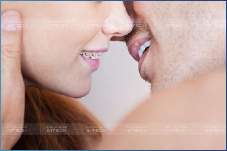 Niềng răng mắc cài mặt ngoài có thể giúp bạn nụ hôn bình thường
