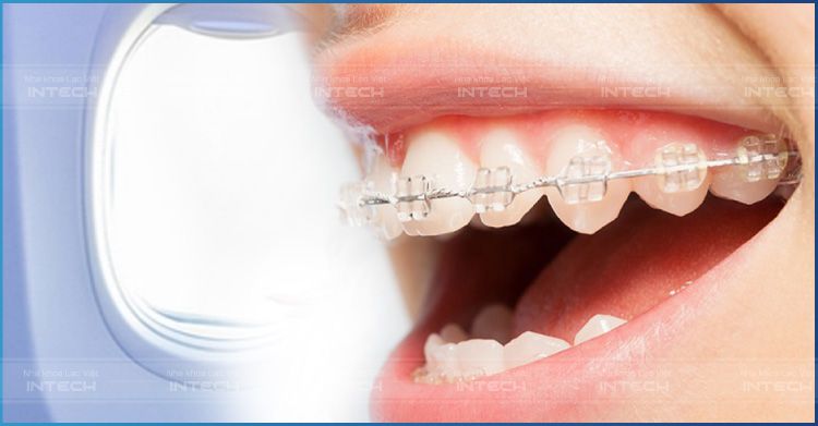 Sau khi niềng răng bằng mắc sứ giúp khách hàng đi máy bay bình thường Sau khi niềng răng bằng mắc sứ giúp khách hàng đi máy bay bình thường