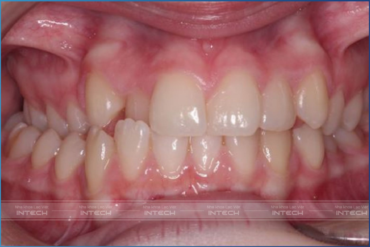 Răng gặp trình trạng khớp cắn chéo Răng gặp trình trạng khớp cắn chéo