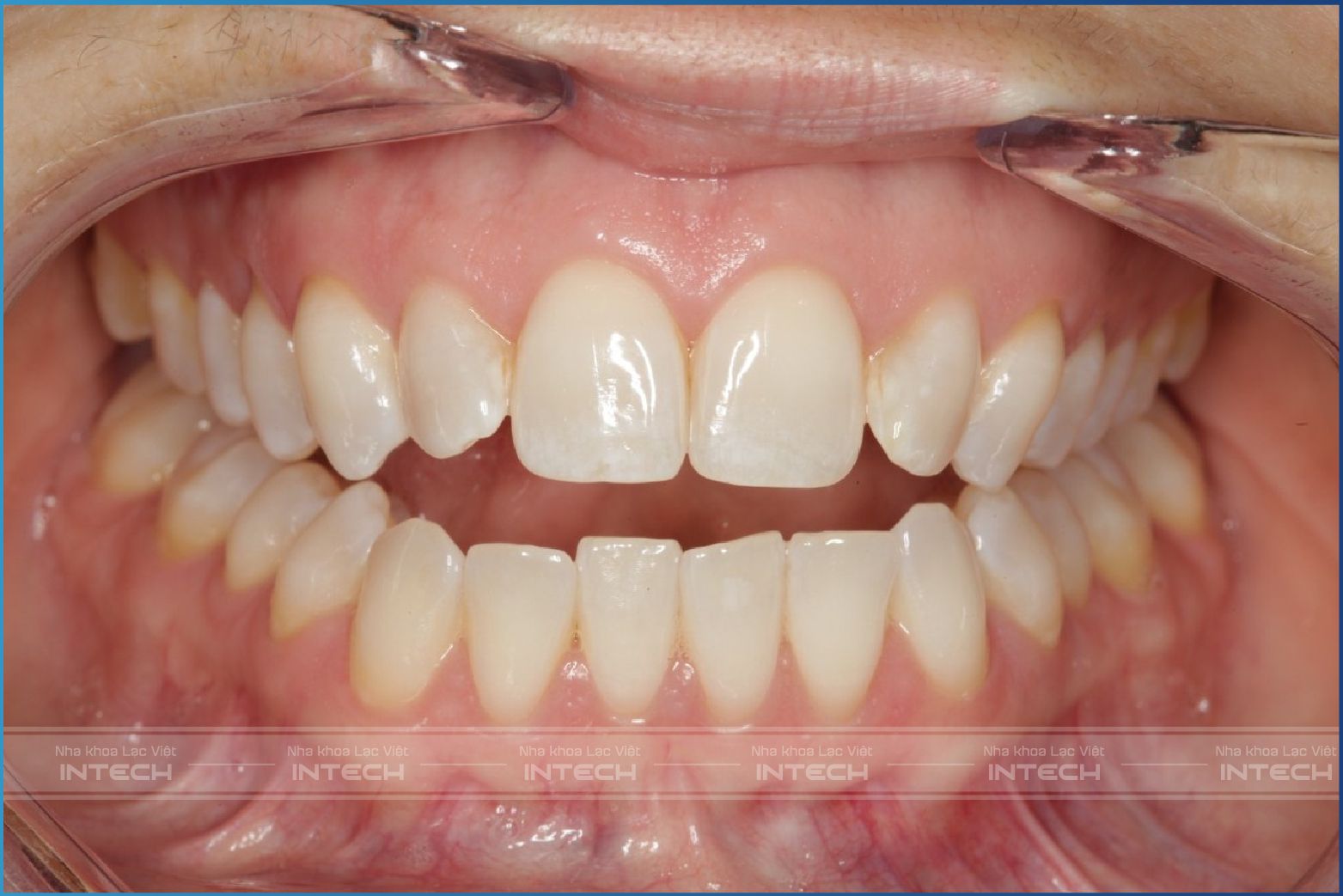 Răng lệch khớp cắn hở Răng lệch khớp cắn hở