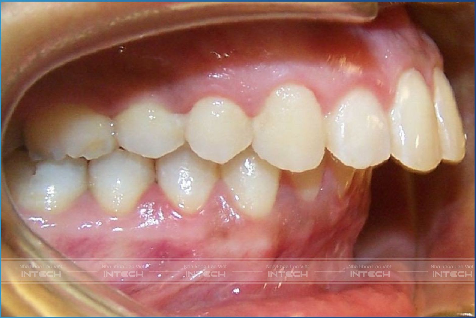 Biểu hiện răng sai khớp cắn hô dễ nhận biết Biểu hiện răng sai khớp cắn hô dễ nhận biết
