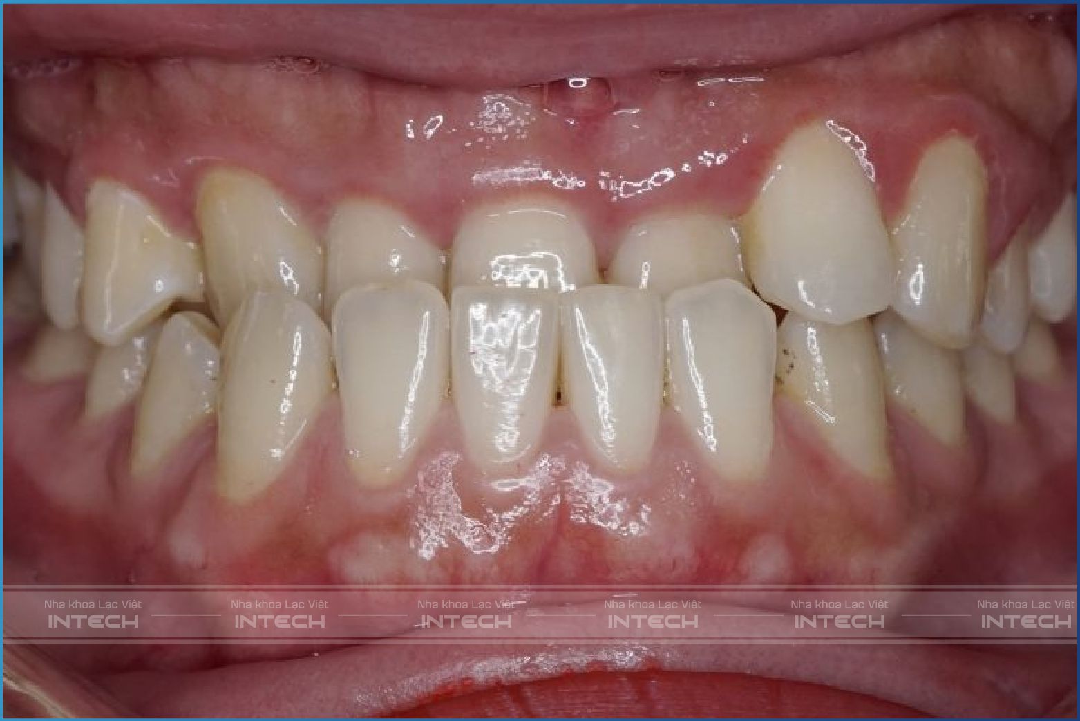 Tình trạng răng khớp cắn ngược khá phổ biến hiện nay Tình trạng răng khớp cắn ngược khá phổ biến hiện nay