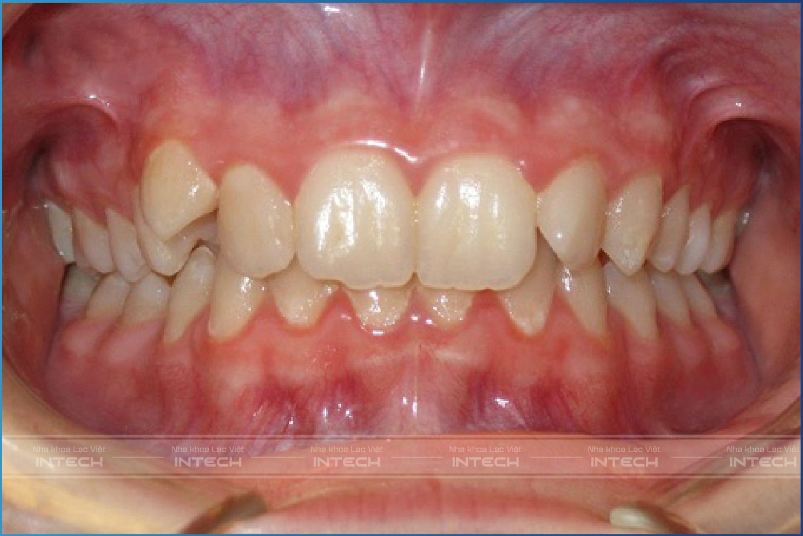 Răng lệch khớp cắn sâu Răng lệch khớp cắn sâu