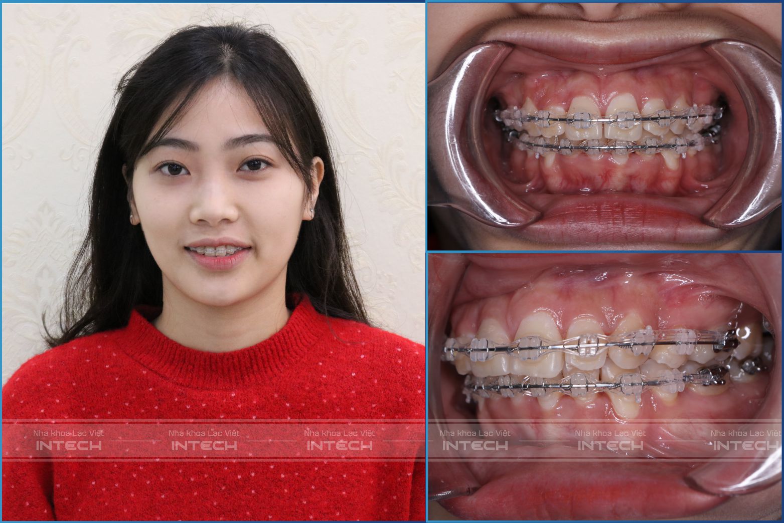 Sự thay đổi bất ngờ sau hơn 1 năm đeo niềng Sự thay đổi bất ngờ sau hơn 1 năm đeo niềng