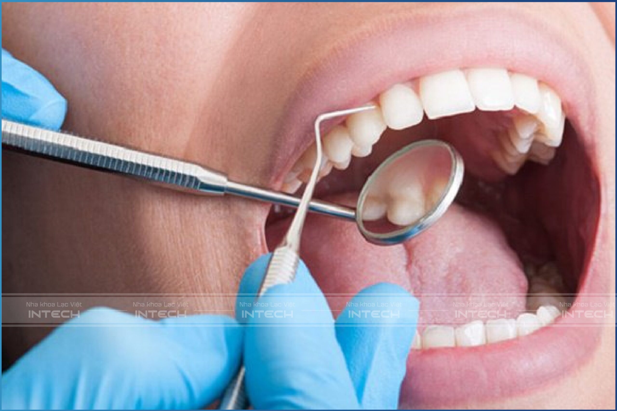 Cạo vôi răng tránh ảnh hưởng đến các bệnh lý về răng khi chỉnh nha