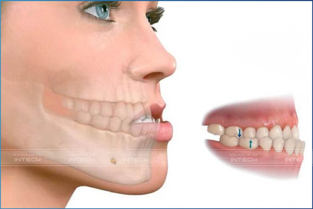 Hình ảnh mô phỏng răng móm - một trong những sai lệch phổ biến trên răng 