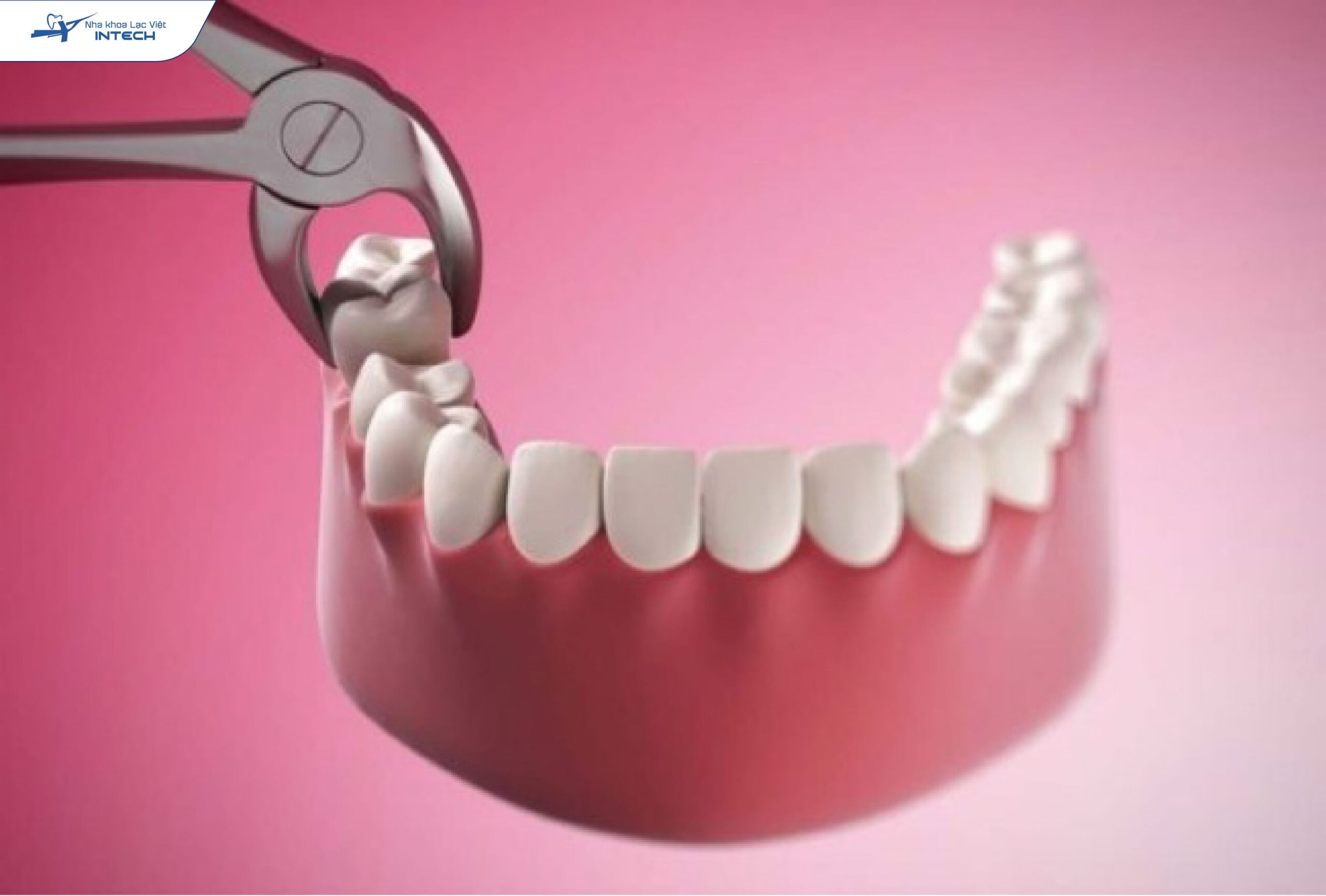 4 răng thường gặp phổ biến khi chỉnh nha cần phải nhổ
