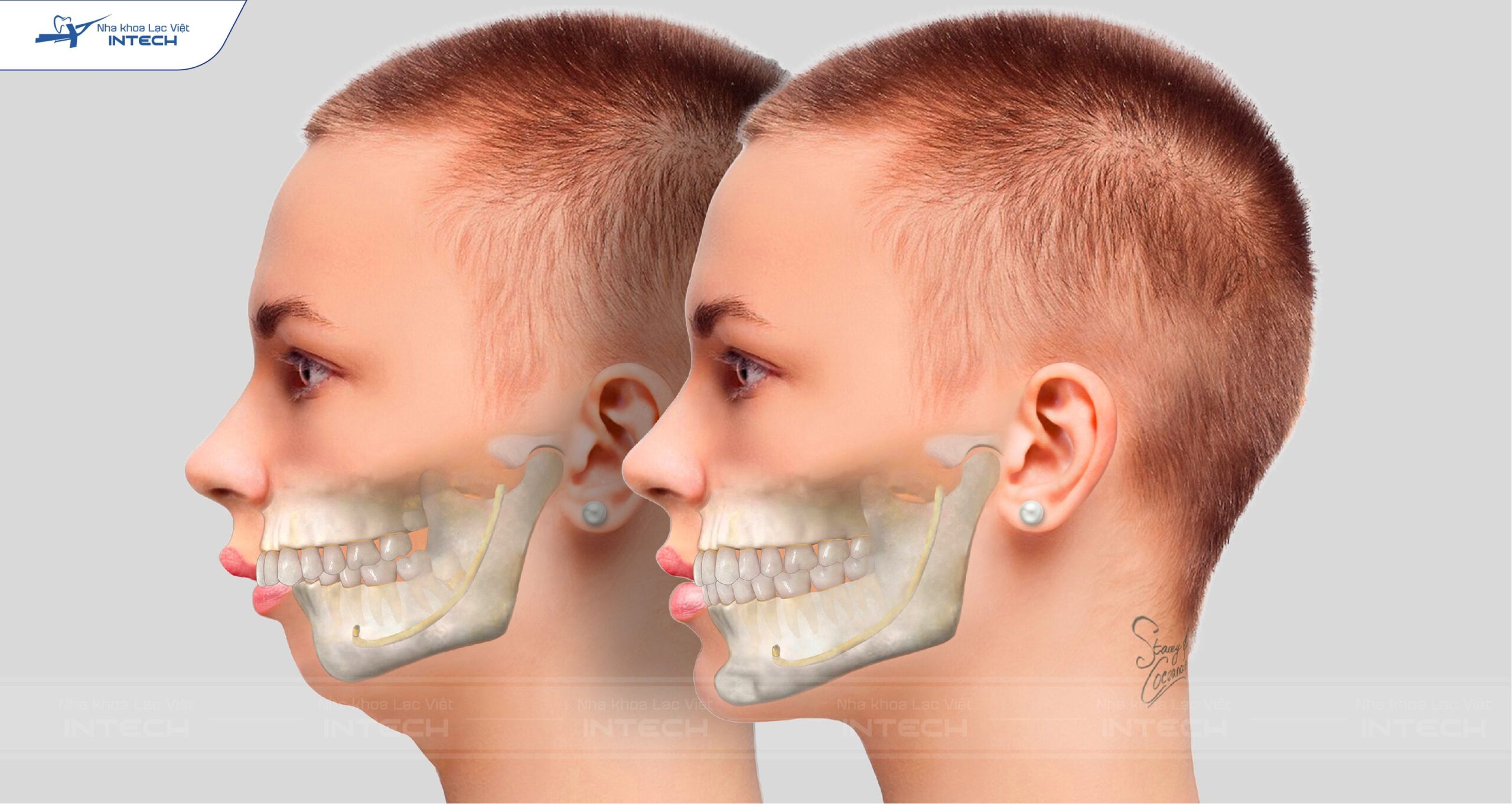 Hô do xương hàm thường gặp nhiều trong cuộc sống Hô do xương hàm thường gặp nhiều trong cuộc sống