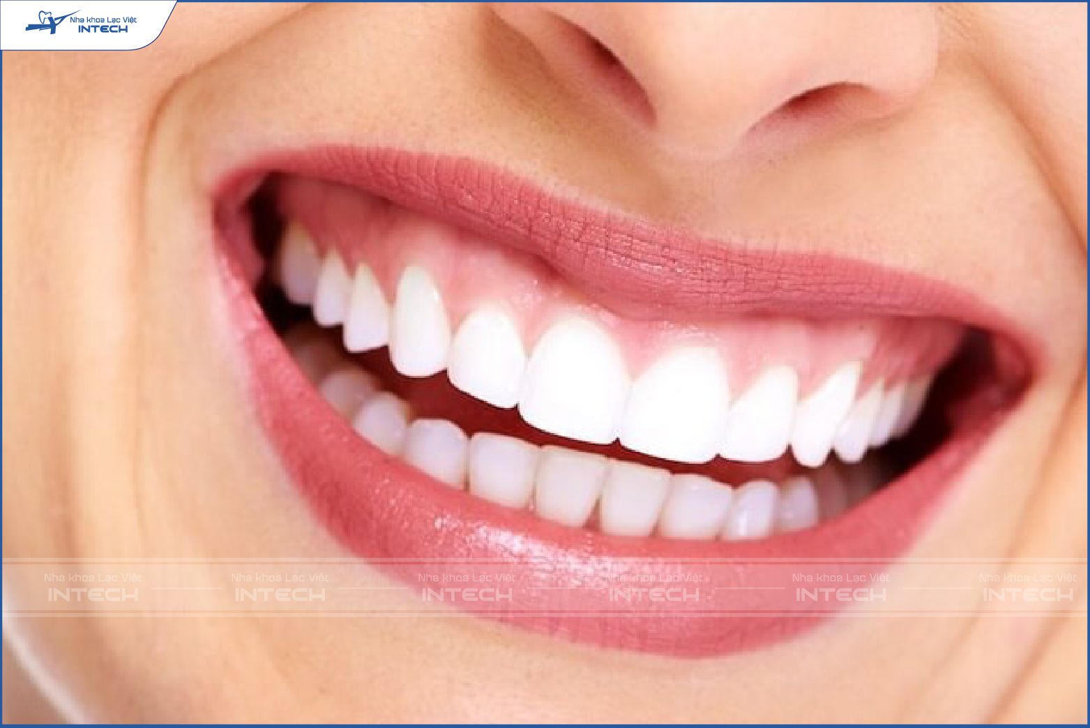 Nhóm răng cửa (số 1 và 2) có 8 chiếc răng