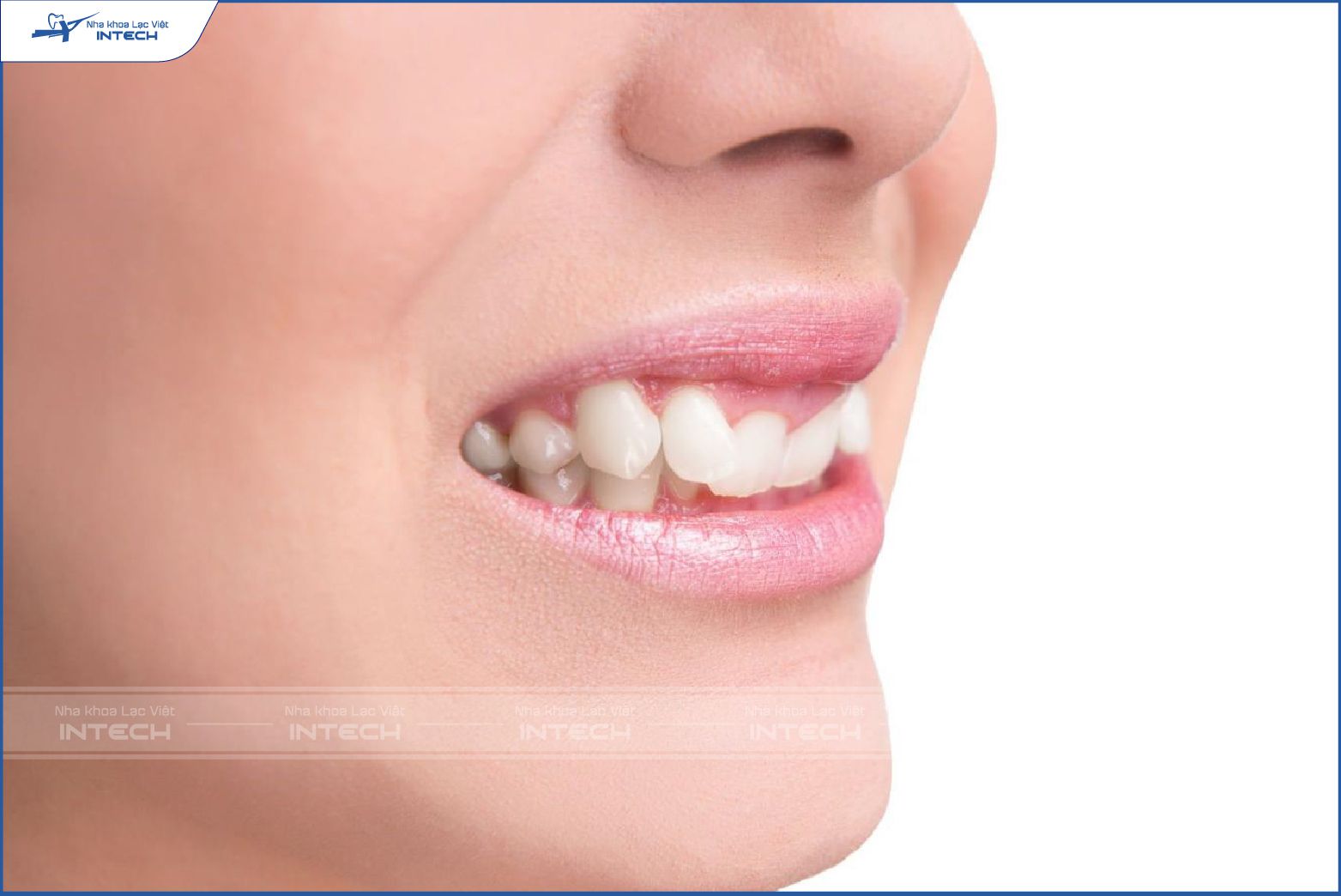Nhóm răng nanh (răng số 3) có 4 chiếc răng