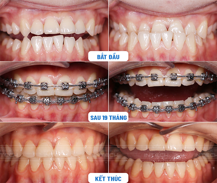 Tình trạng răng không chỉ tác động đến thời gian, hiệu quả điều trị mà còn ảnh hưởng đến chi phí