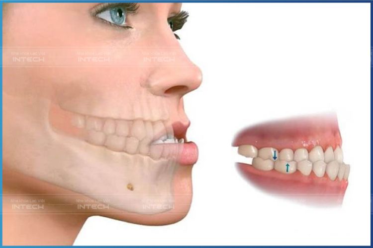 Dấu hiện tình trạng răng móm do răng và xương