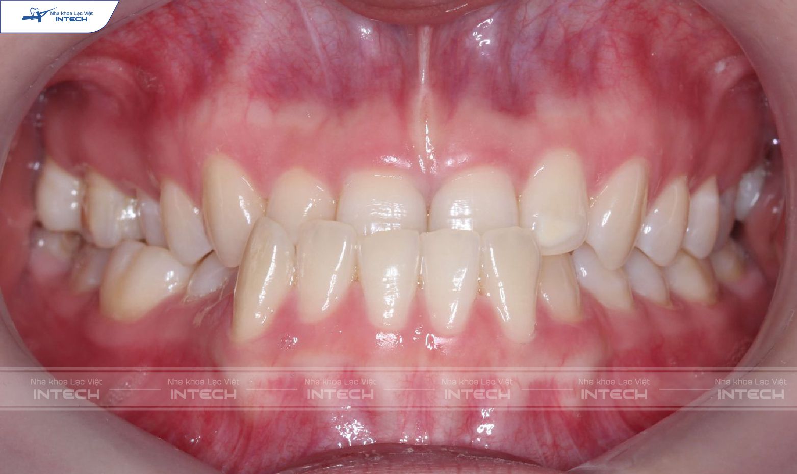 Thân răng cửa hàm trên ngắn là một trong nguyên nhân cười hở lợi