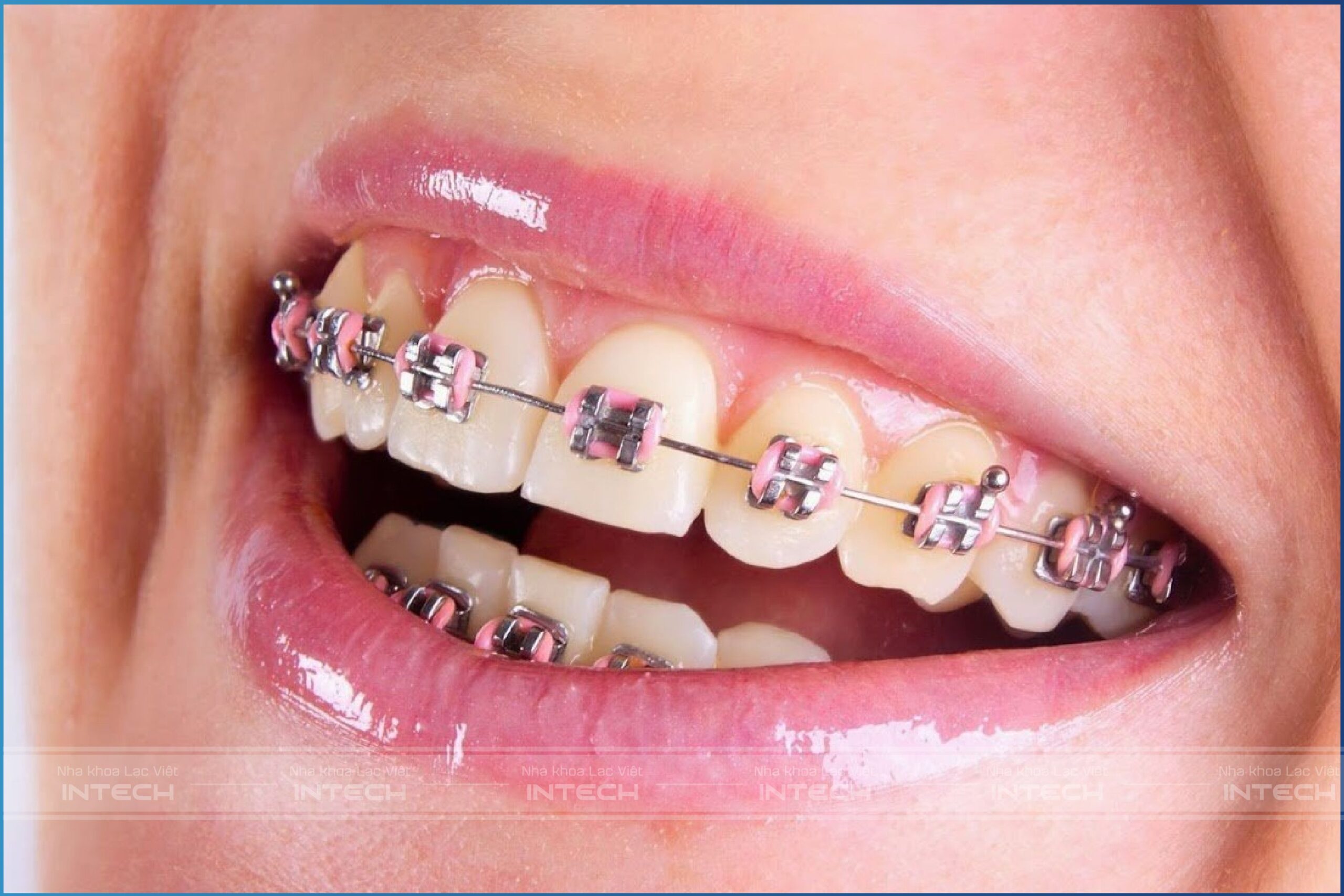 Tháo tạm mắc khi chỉnh nha mắc cài mặt ngoài