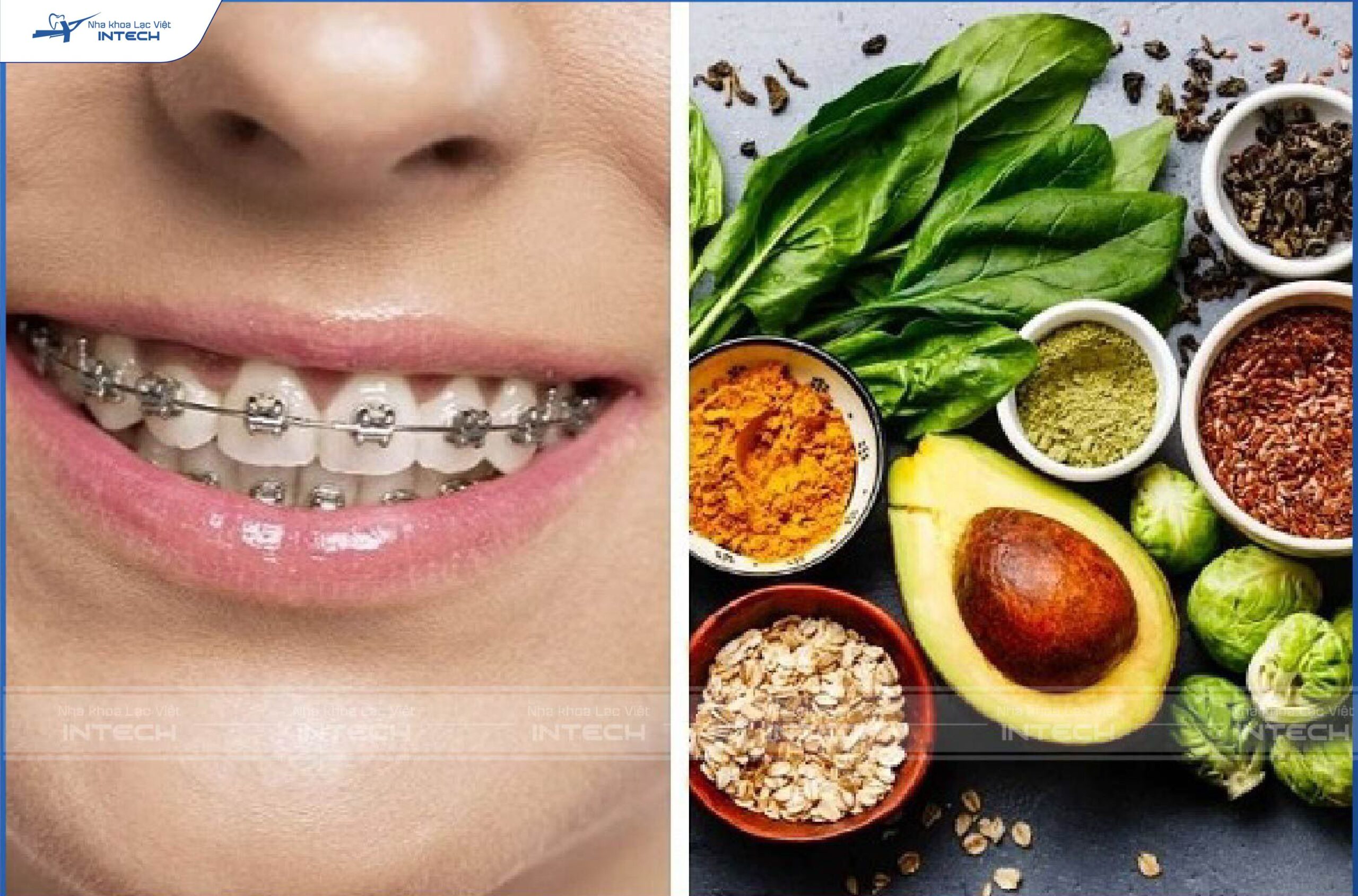 Chế độ dinh dưỡng không đảm bảo dẫn đến răng gặp gò má cao